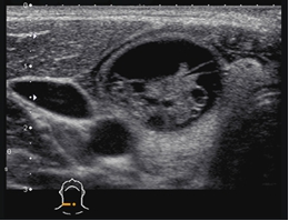 ultrasound-thyroid.jpg